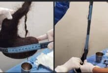 Extraen masa de cabello del estómago de una niña de 3 años en Yucatán